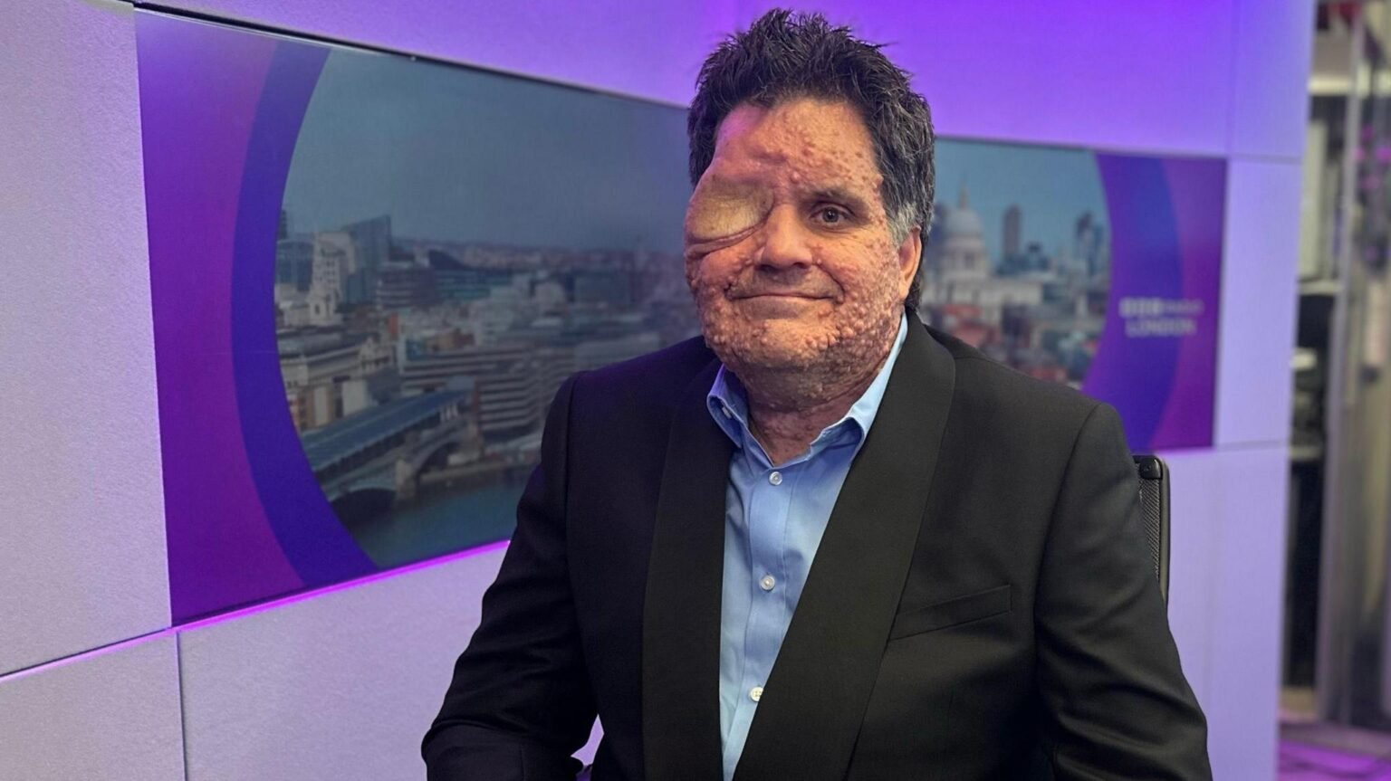 Olivier Bromley vit avec la neurofibromatose. Il est devenu une sorte de célébrité en Angleterre après avoir été ouvertement discriminé dans un restaurant. ©BBC